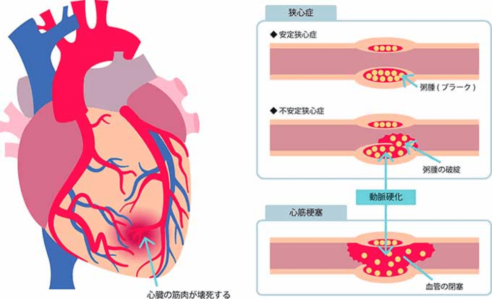 狭心症のメカニズム