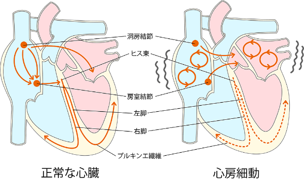 心房細動の様子