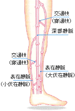 下肢静脈瘤の説明図